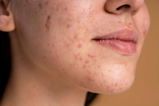 Gut health and acne sales