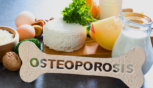 Preventing Osteoporosis: Which is the Best Probiotic for Bone Health?